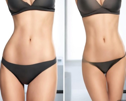 腹部吸脂，专业解析与个性化方案